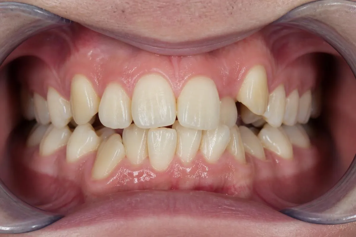 Clear Aligners before